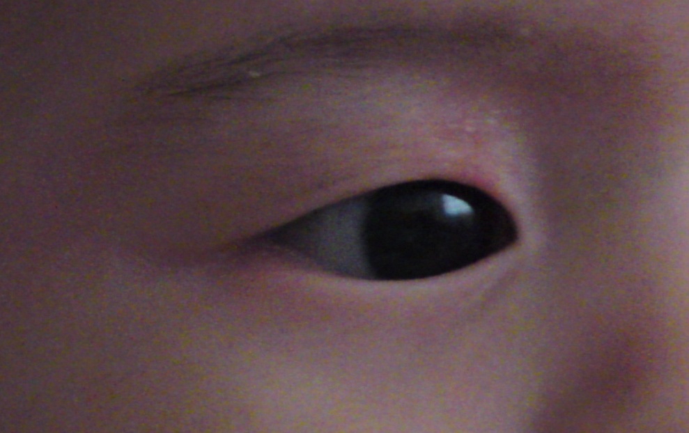eyelid eczema #10