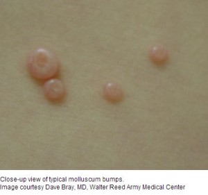 molluscum contagiosum eczema