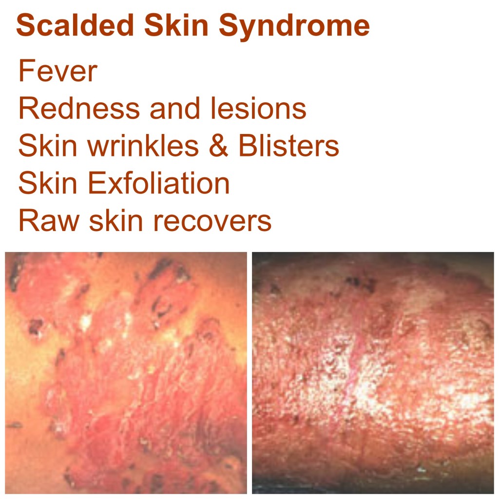 scalded skin syndrome pictures