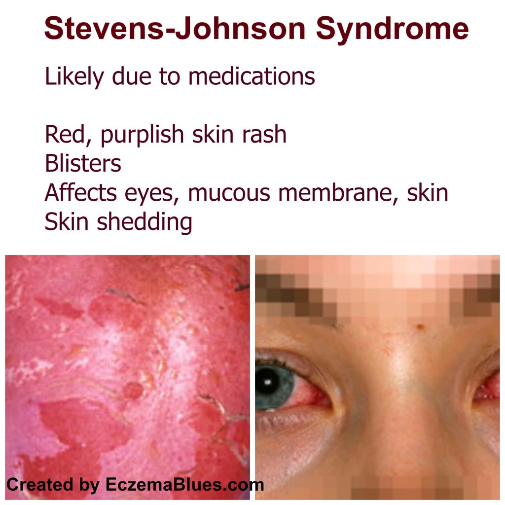stevens johnson syndrome causes