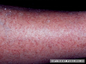 Elderly Skin Conditions series - Asteatotic Eczema (Xerosis or Cracked ...